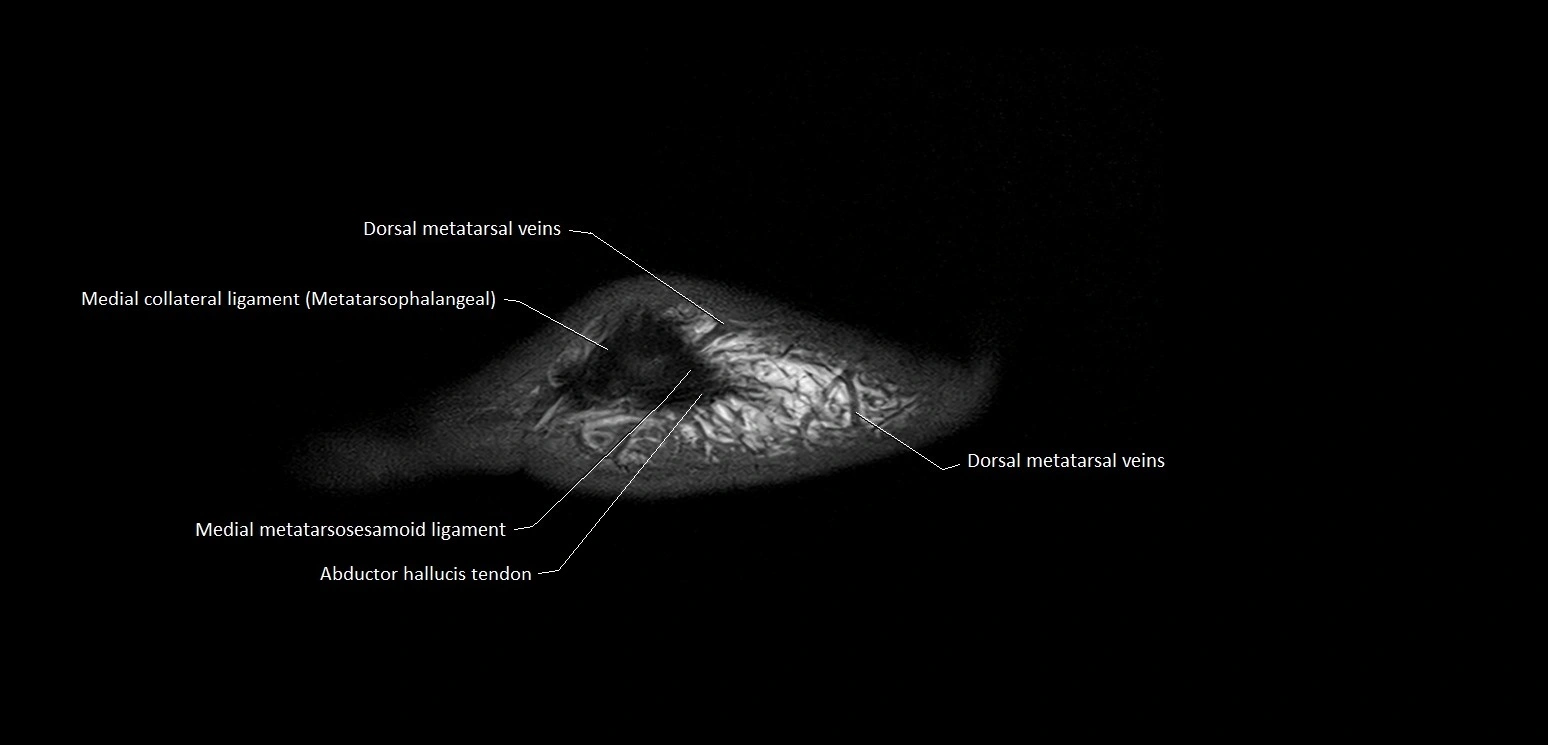Hallux or big toe sagittal anatomy 3T MRI image 3.webp